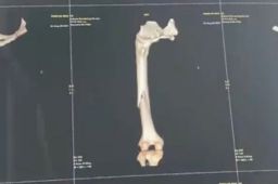 女子首次上瑜伽课 被老师压断大腿