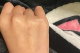 两网友自称在广州街头被人扎针